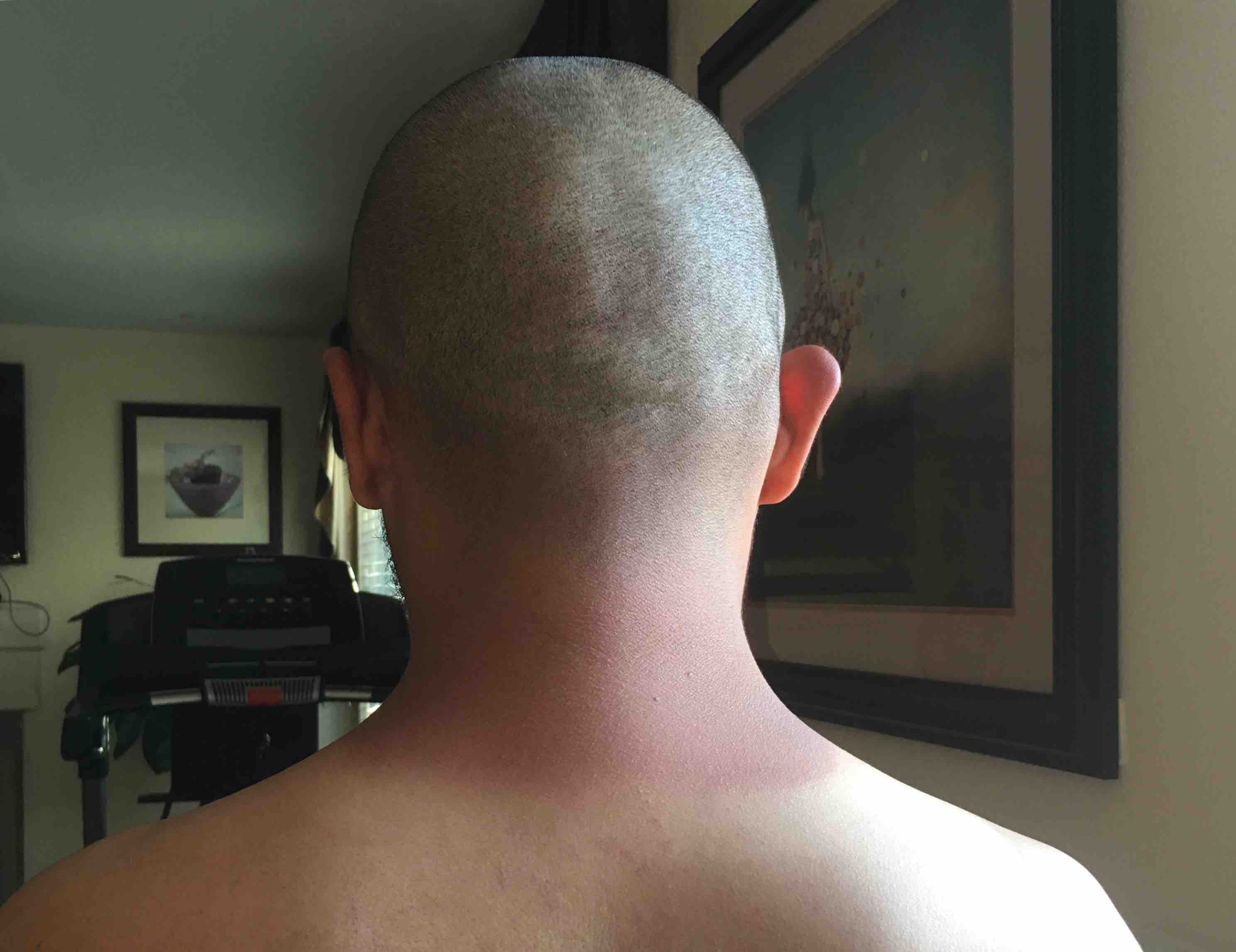 burnt neck